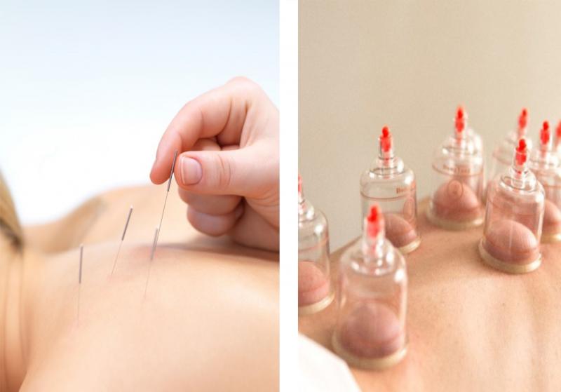 CURSO DE DRY NEEDLING E VENTOSATERAPIA CURSO DE DRY NEEDLING E VENTOSATERAPIA